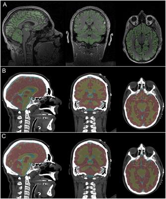 Brain Segmentation From Computed Tomography of Healthy Aging and Geriatric Concussion at Variable Spatial Resolutions